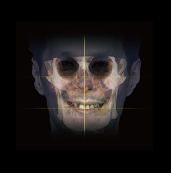 Sinus Simple
